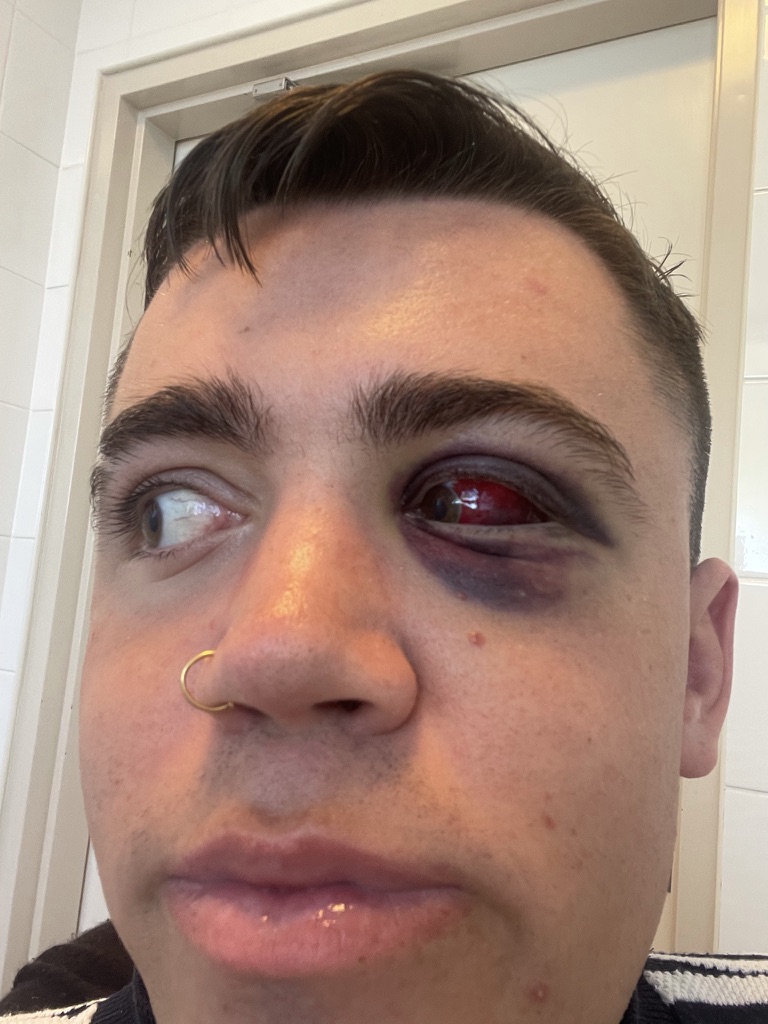 Another angle of Tom’s black eye, showing redness in the eye.